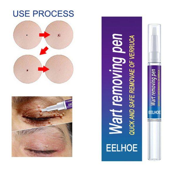 🖊️ Wart Remover Gel Pen Fast & Effective 💨✨